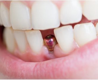 riscuri implant dentar