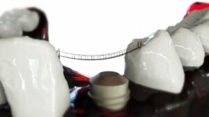 Implantul dentar NOVODENT