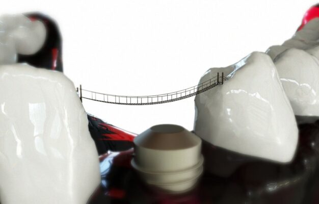 Implantul dentar NOVODENT